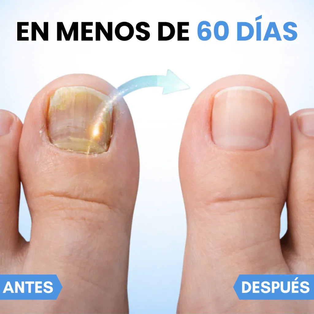 PARCHES ANTIHONGOS PARA UÑAS- SIENTE CONFIANZA TOTAL