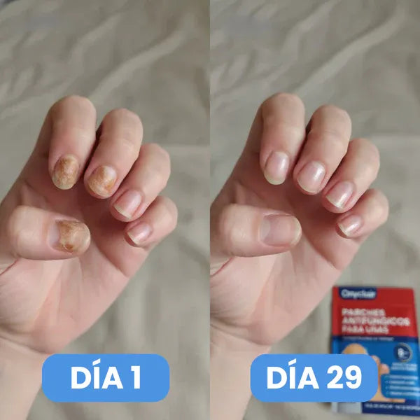 PARCHES ANTIHONGOS PARA UÑAS- SIENTE CONFIANZA TOTAL